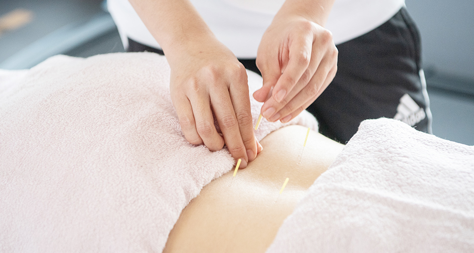 アドバンスプラン鍼（ごう鍼）＋シール鍼